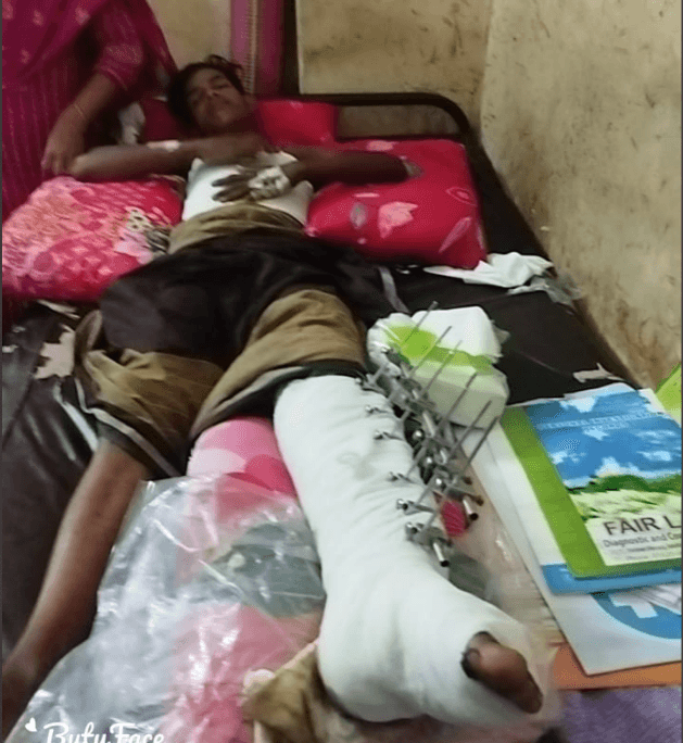 ভয়াবহ সড়ক দুর্ঘটনায় এক পা হারানো রাকিব এখনো হাটার স্বপ্ন দেখছে!